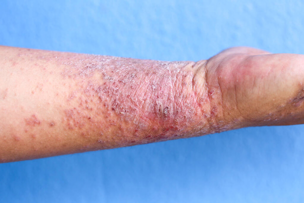 Atopische dermatitis (AD), ook bekend als atopisch eczeem, is een type ontsteking van de huid (dermatitis). - Foto, afbeelding