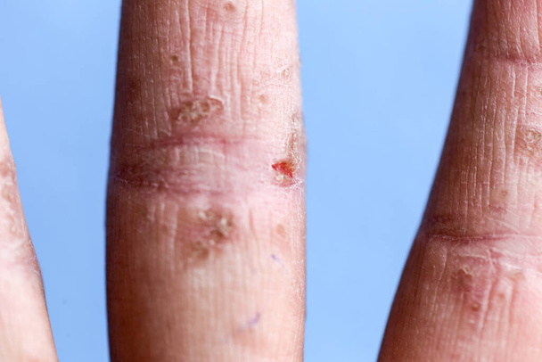 Atopowe zapalenie skóry (AD), znany również jako wyprysk atopowy, jest rodzajem zapalenia skóry (zapalenie skóry). - Zdjęcie, obraz