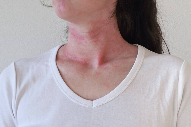女性の首と顔にアレルギー性皮膚反応 - 写真・画像