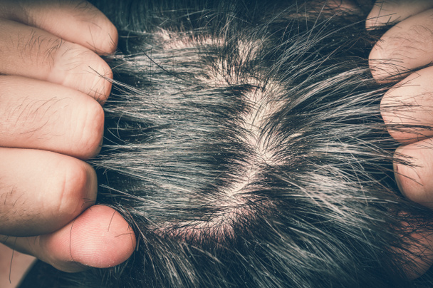 Closeup view of hair of a man with dandruff - psoriasis concept - retro style - Zdjęcie, obraz