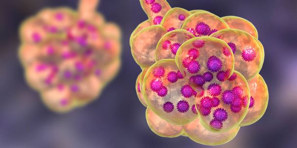 Coronavirus pneumonia, Covid-19-cel töltött alveolusok Novel Chinese Wuhan coronavirus, 2019-nCoV, 3D illusztráció - Fotó, kép