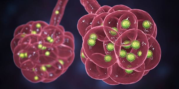 Polmonite da Coronavirus, alveoli riempiti con Covid-19 Novel Chinese Wuhan coronavirus, 2019-nCoV, illustrazione 3D - Foto, immagini
