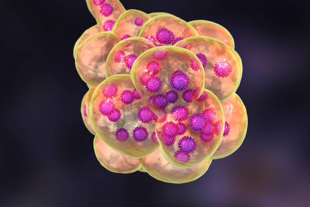 Коронавирус пневмонии, альвеолы, наполненные Ковидом-19 Роман Китайский коронавирус, 2019-nCoV, 3D иллюстрация
 - Фото, изображение