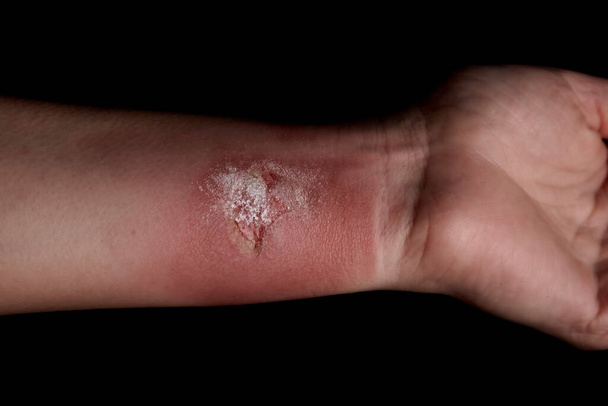 Temperature burn on the arm. Hand wound treatment. injured arm. Red skin. - Φωτογραφία, εικόνα