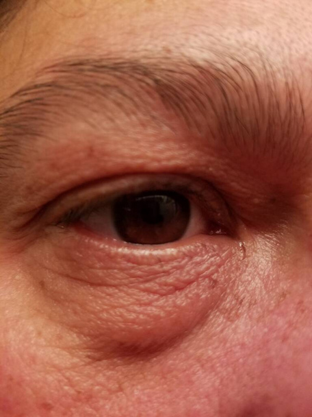 червоне пухке запалене коричневе око на жіночому
 - Фото, зображення