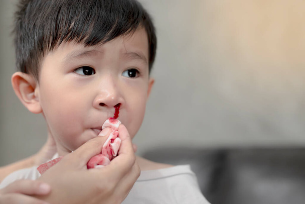 Portrait of cute Asian ethnic child having nosebleed,The concept of first aid for nosebleeds. - Photo, Image