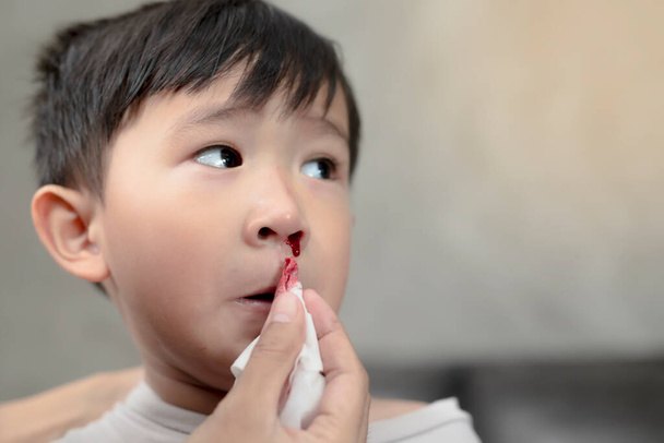 Portret uroczego azjatyckiego dziecka pochodzenia etnicznego krwawiącego z nosa, Koncepcja pierwszej pomocy przy krwotokach z nosa. - Zdjęcie, obraz