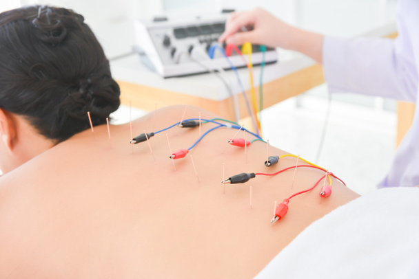 Aziatische vrouw ontvangt acupunctuur met elektrische stimulator aan de achterkant, Alternatieve geneeskunde concept. - Foto, afbeelding