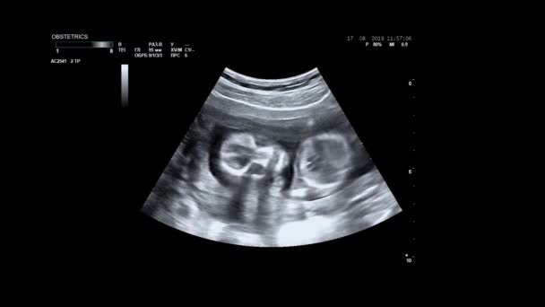 Ultrassonografia de mulher grávida. Ultra-som do corpo do bebê e coluna vertebral. O bebé está a entregar a barriga às mães. 16 semanas de vida. Bebê no útero das mães está se movendo durante a ultrassonografia
. - Filmagem, Vídeo
