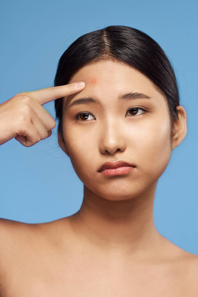 Joven hermosa mujer asiática molesto por el acné. Captura de estudio
  - Foto, imagen