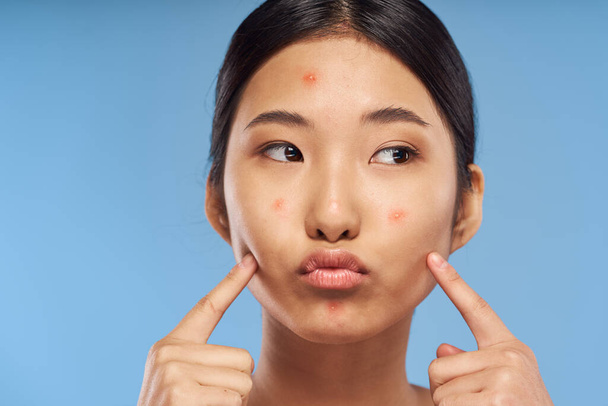 Young beautiful asian  woman upset about acne. Studio shot  - 写真・画像