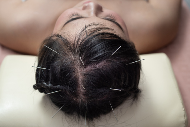 Acupuncture to the head .hair Glabrous - Photo, Image