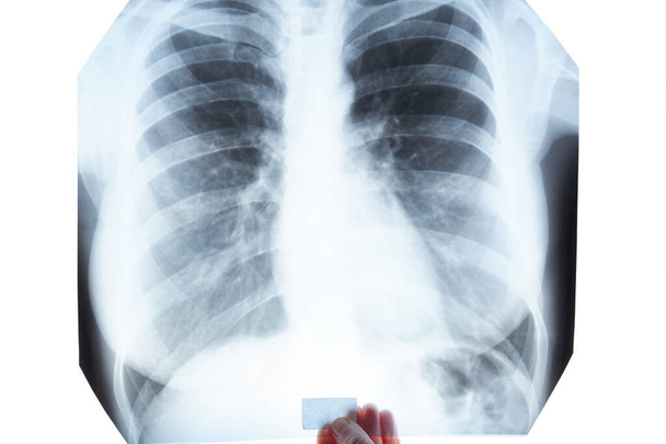 Radiografía de los pulmones en la mano sobre fondo blanco. Aislado
 - Foto, imagen