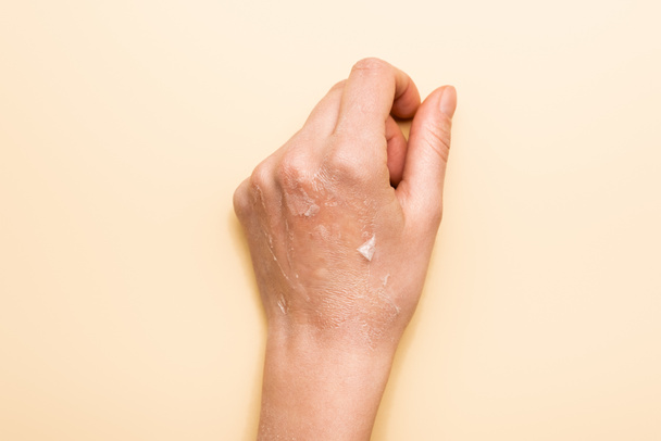 Ausgeschnittene Ansicht der weiblichen Hand mit dehydrierter, peelender Haut auf beige - Foto, Bild