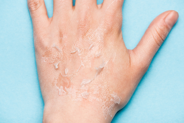 gedeeltelijk zicht op vrouwelijke hand met droge, gescrubde huid op blauw - Foto, afbeelding