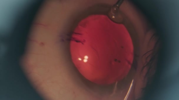 Czyszczenie zaćmy w oku. Nagranie makro z operacji oczu. Chirurgia okulistyczna. - Materiał filmowy, wideo