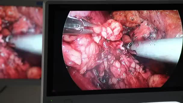Οι γιατροί χρησιμοποιούν ενδο-όργανα και βιντεοκάμερες για να κάνουν εγχείρηση στην κοιλιακή κοιλότητα ενός χοντρού. Νέες τεχνολογίες στην ιατρική. Λαπαροσκοπική χειρουργική στην οθόνη. - Πλάνα, βίντεο