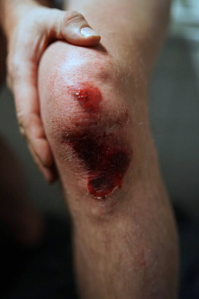 Подряпане коліно після нещасного випадку, відкрита рана з кров'ю
         - Фото, зображення