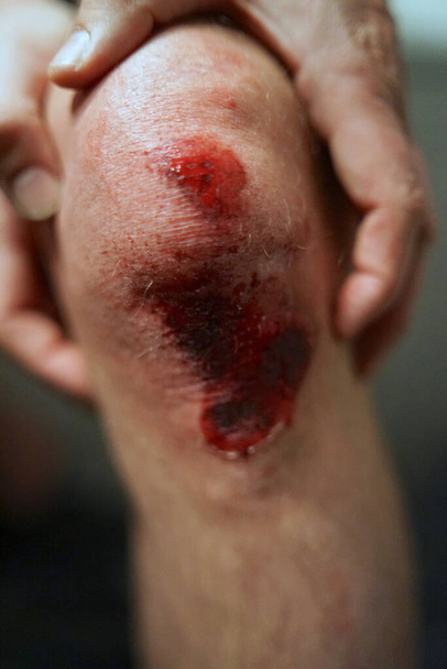 Γδαρμένο γόνατο μετά από ατύχημα, ανοιχτό τραύμα με αίμα         - Φωτογραφία, εικόνα