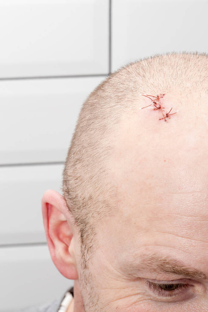 Férfi kopasz fej, sebesüléssel, varratokkal a sérülés után. Közelkép. - Fotó, kép