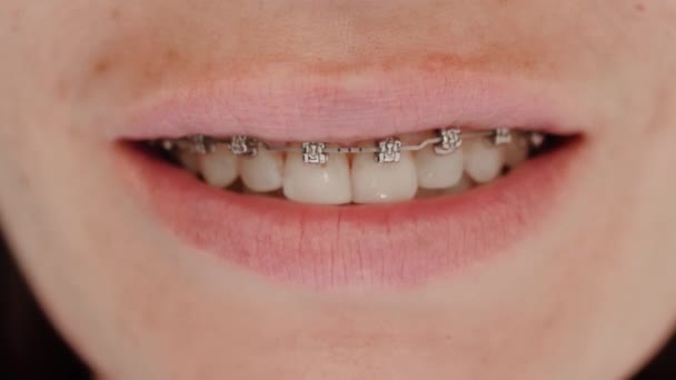 Sourire féminin avec des appareils dentaires - Séquence, vidéo