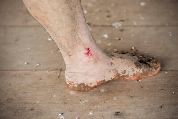  足の潰瘍,傷,創傷治癒,足の傷,男性の足の皮膚の血,怪我,事故,リーチかむ,ブーツなしで水の中を歩くために足の潰瘍への損傷. - 写真・画像