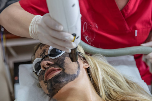 Carbon face peeling procedure. Laser pulseert de schone huid van het gezicht. Hardware cosmetologie behandeling. Proces van fotothermolyse, opwarmen van de huid, laser koolstofpeeling. Gezichtsverjonging. - Foto, afbeelding