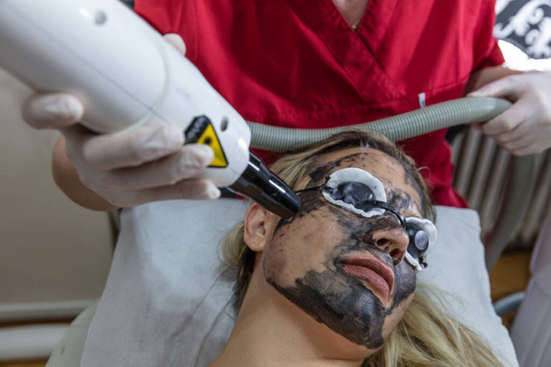 Peeling visage carbone. Les impulsions laser nettoient la peau du visage. Cosmétologie du matériel. Le processus de photothermolyse, le réchauffement de la peau. Rajeunissement de la peau faciale. - Photo, image