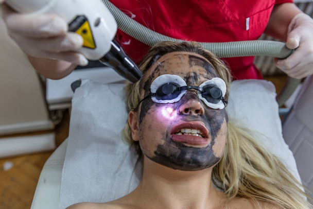 Koolstofgezicht afpellen. Laserpulsen reinigen de huid van het gezicht. Hardware cosmetologie. Het proces van fotothermolyse, het verwarmen van de huid. Gezichtsverjonging. - Foto, afbeelding
