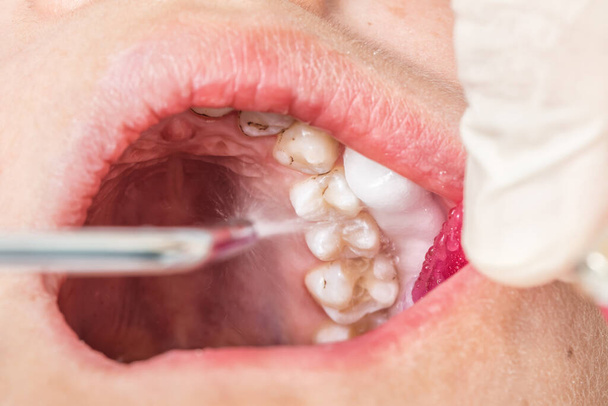 Η λειτουργία της πλήρωσης των δοντιών στο στόμα ενός παιδιού υπό το φως από οδοντιατρική καρέκλα και φως LED από οδοντιατρική αεροτομή. Επιλεκτική εστίαση. - Φωτογραφία, εικόνα