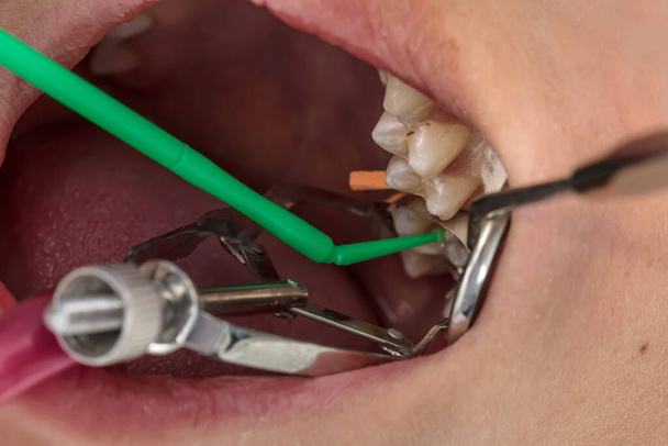 L'opération de remplissage des dents dans la bouche d'un enfant sous la lumière de la chaise dentaire et la lumière LED de l'aérotor dentaire. Concentration sélective. - Photo, image