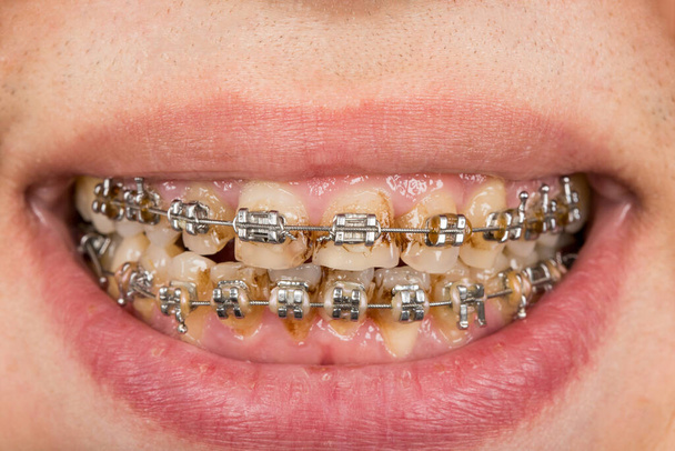 closeup of a mouth with braces   - 写真・画像