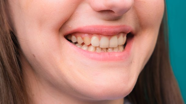 Żółte zęby, fluoroza. Palacze mają problem z zębami spowodowanymi fluorem, paleniem lub kawą. Brązowa emalia z powodu choroby i medycyny. Naturalne zdjęcie. - Zdjęcie, obraz