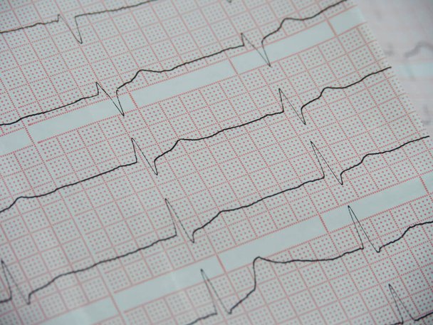 Elektrokardiographie eines Herzens auf weißem Papier mit roten Zellen, Nahaufnahme schräg. - Foto, Bild