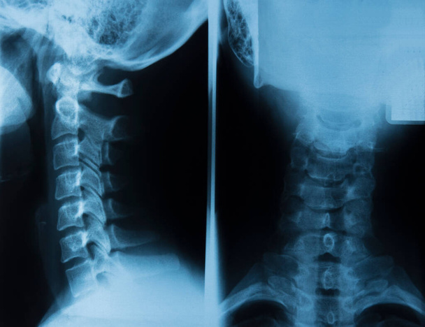 Röntgenkép egy osteochondrosisos nő nyaki gerincéről és a csigolyák elmozdulásáról. - Fotó, kép