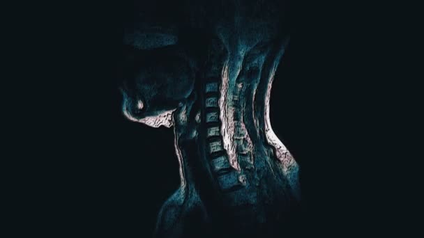 Wielobarwny MRI kręgosłupa szyjnego, wykrywanie występów i przepukliny - Materiał filmowy, wideo