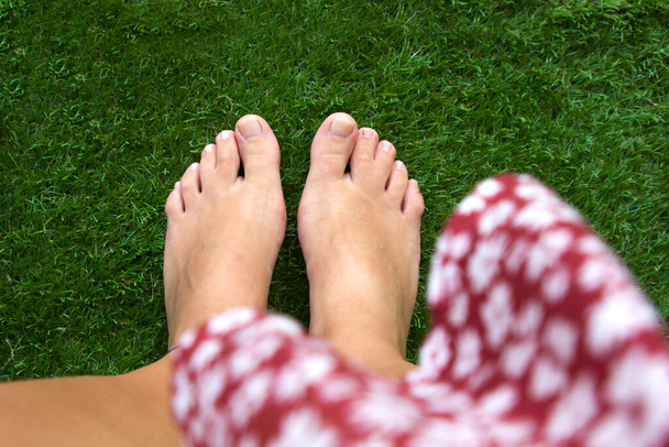 widok górny żeńskich nóg z połączonymi środkowymi palcami na zielonym tle trawy. Pęknięte palce u nóg, zaburzenia genetyczne i syndrom, syndactyly palców u nóg. Specjalni ludzie. - Zdjęcie, obraz