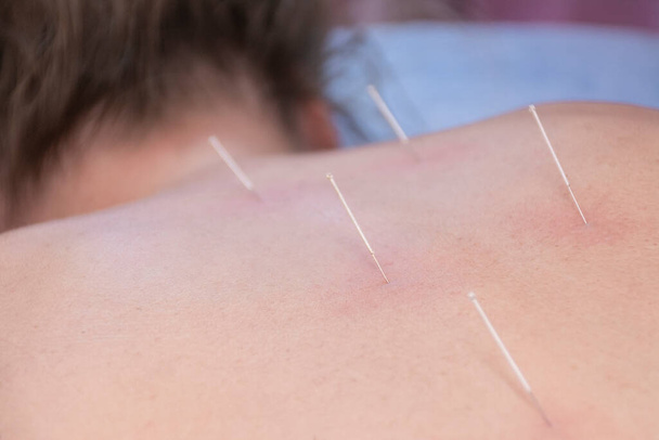 Dos d'une femme méconnaissable avec cinq aiguilles d'acupuncture sur le dos, à côté de sa colonne vertébrale. Concentration sélective - Photo, image