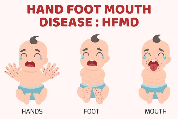 MKS-Kinder infiziert. Hand-Fuß-Mund-Krankheit mit Symptomen. Cartoon Gesundheitskonzept Vektor Illustration. - Vektor, Bild