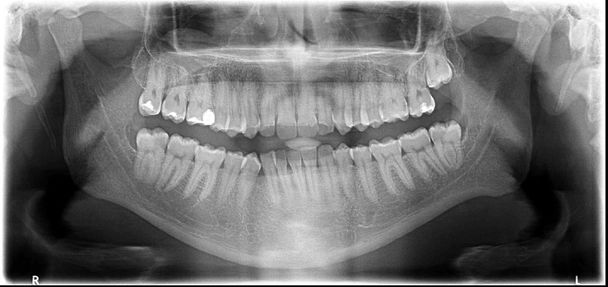 raio-X da mandíbula
 - Foto, Imagem