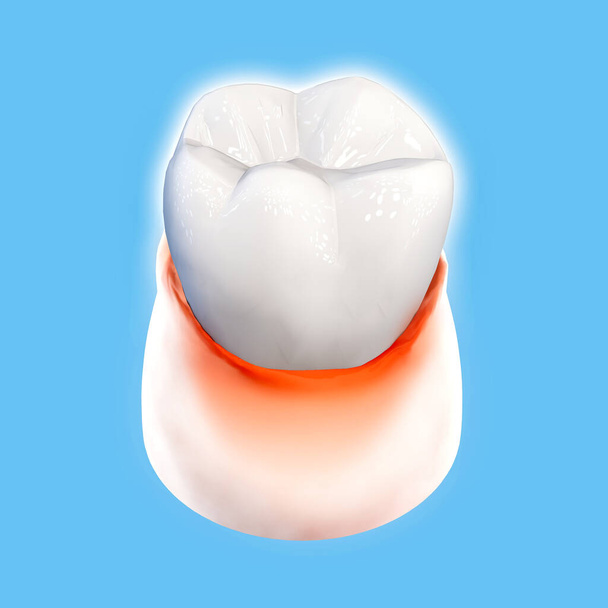 Tooth, sore gum, redness, dentistry, dental cleaning, oral hygiene. Using toothpaste to protect the tooth from plaque formation, 3d render - Photo, Image