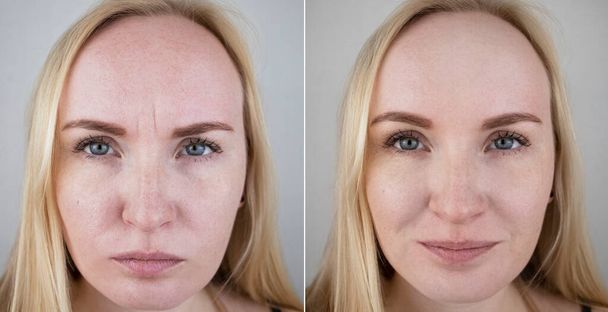 Fotos vor und nach der Mesotherapie, Biorevitalisierung, Botulinumtoxin-Injektionen. Hautfalte zwischen Augenbrauen, Stirnfalten. Zum Termin beim plastischen Chirurgen oder Kosmetologen - Foto, Bild