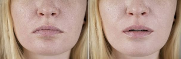 Zdjęcia żeńskich warg przed i po cheiloplastyce. Korekta wypadania kącików ust, wstrzyknięcie toksyny botulinowej, kwasu hialuronowego, wypełniaczy. Budowanie twarzy lub kosmetologia - Zdjęcie, obraz