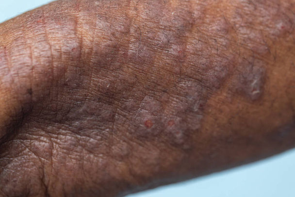 Un physique de la dermatite atopique (AD), également connu sous le nom d'eczéma atopique, est un type d'inflammation de la peau (dermatite). - Photo, image