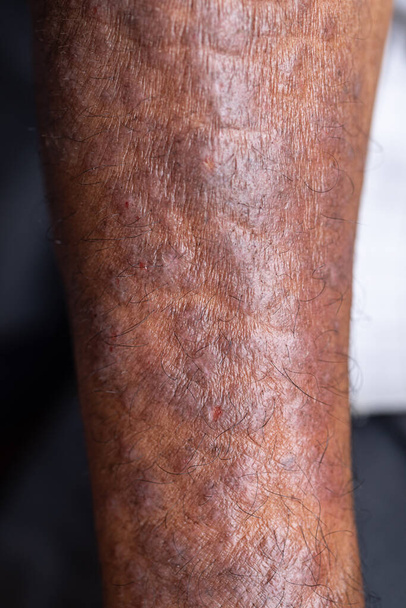 A fizikai Atópiás dermatitis (AD), más néven atópiás ekcéma, egy olyan típusú gyulladás a bőr (dermatitis). - Fotó, kép