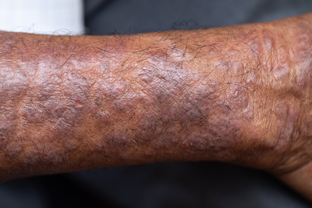 Un físico de la dermatitis atópica (DA), también conocida como eccema atópico, es un tipo de inflamación de la piel (dermatitis). - Foto, imagen