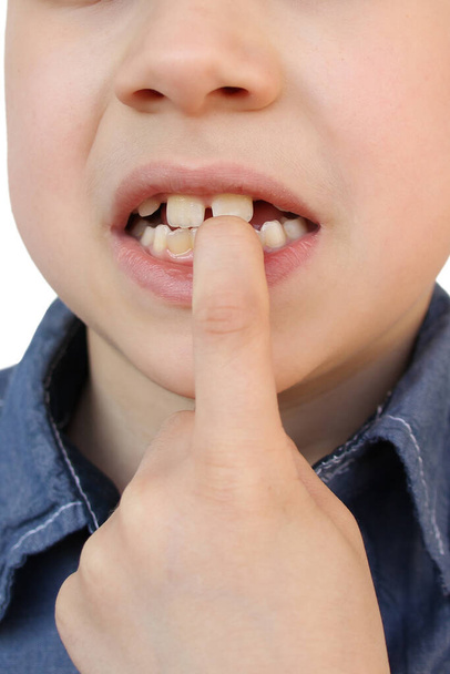 child, kid shows with his finger a milk tooth that sways and hurts, the concept of pediatric dentistry, dental treatment and correction of occlusion, oral care - Foto, immagini
