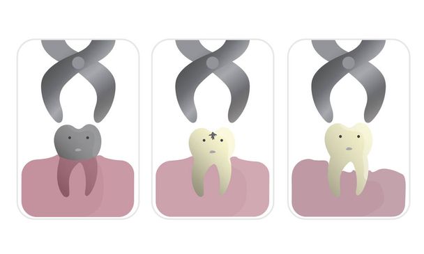 Odstranění zubů extrakčními kleštěmi u různých druhů nemocí - Vektor, obrázek