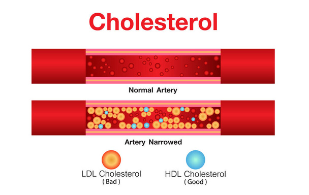 Colesterolo nell'arteria, rischio per la salute, progettazione vettoriale. - Vettoriali, immagini