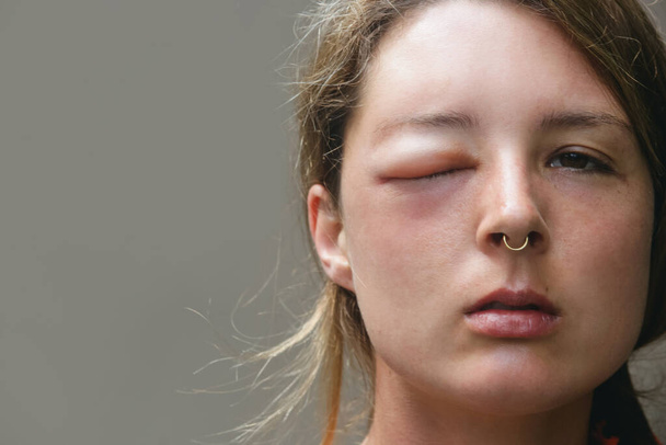 Junge Kaukasierin mit einem geschwollenen Auge nach einem Wespenstich. Allergische Reaktion auf Wespenstich. - Foto, Bild